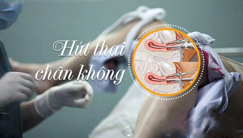 Phá thai mới dính bằng phương pháp hút chân không